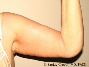 Arm Lift Before and After 02 | Sanjay Grover MD FACS