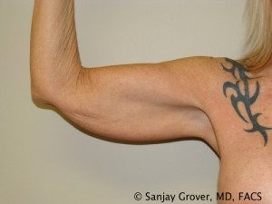 Arm Lift Before and After 08 | Sanjay Grover MD FACS