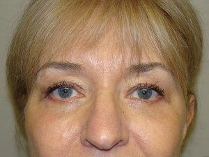 Blepharoplasty Before and After 06 | Sanjay Grover MD FACS