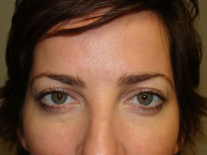 Blepharoplasty Before and After 13 | Sanjay Grover MD FACS