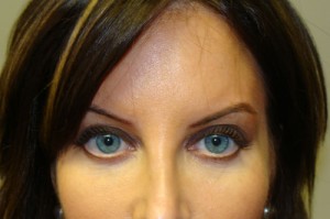 Blepharoplasty Before and After 18 | Sanjay Grover MD FACS