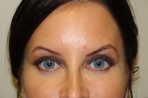 Blepharoplasty Before and After | Sanjay Grover MD FACS