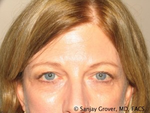 Blepharoplasty Before and After 28 | Sanjay Grover MD FACS