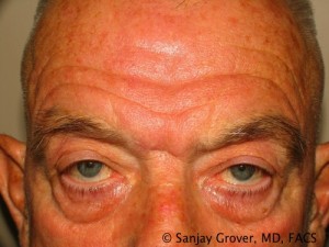 Blepharoplasty Before and After 29 | Sanjay Grover MD FACS