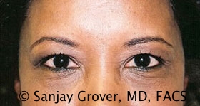 Blepharoplasty Before and After 22 | Sanjay Grover MD FACS