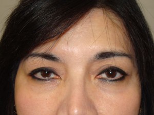 Blepharoplasty Before and After 36 | Sanjay Grover MD FACS