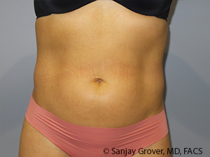 Liposuction Before and After 51 | Sanjay Grover MD FACS