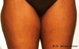 Liposuction Before and After 05 | Sanjay Grover MD FACS
