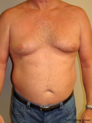 Liposuction Before and After 51 | Sanjay Grover MD FACS