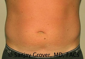Liposuction Before and After 47 | Sanjay Grover MD FACS