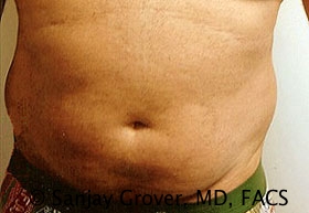 Liposuction Before and After 43 | Sanjay Grover MD FACS