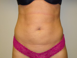 Liposuction Before and After 43 | Sanjay Grover MD FACS