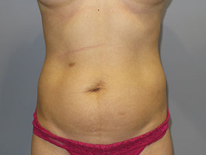 Liposuction Before and After 64 | Sanjay Grover MD FACS