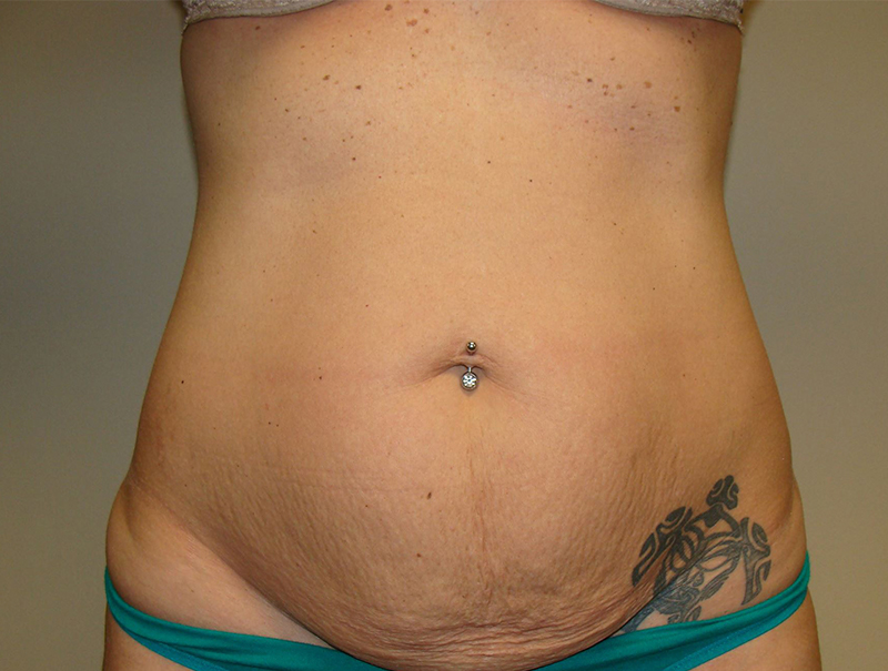 Tummy Tuck Before and After 13 | Sanjay Grover MD FACS