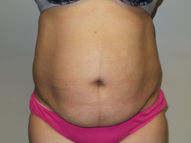 Tummy Tuck Before and After 38 | Sanjay Grover MD FACS
