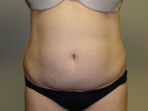 Tummy Tuck Before and After 09 | Sanjay Grover MD FACS