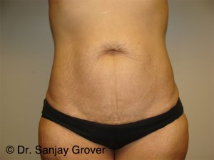 Tummy Tuck Before and After 88 | Sanjay Grover MD FACS