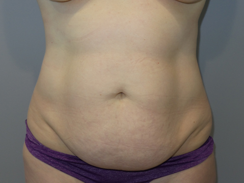Tummy Tuck Before and After 37 | Sanjay Grover MD FACS