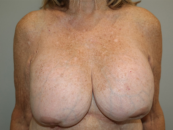 Breast Revision Before and After 52 | Sanjay Grover MD FACS