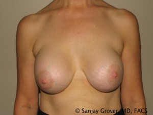 Breast Revision Before and After 58 | Sanjay Grover MD FACS