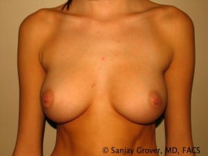 Breast Revision Before and After 03 | Sanjay Grover MD FACS
