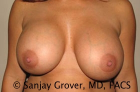 Breast Revision Before and After 01 | Sanjay Grover MD FACS