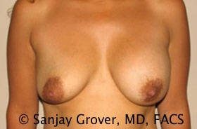 Breast Revision Before and After 52 | Sanjay Grover MD FACS