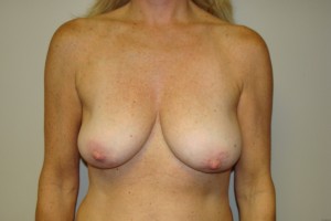 Breast Revision Before and After 03 | Sanjay Grover MD FACS