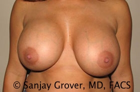 Breast Revision Before and After 05 | Sanjay Grover MD FACS