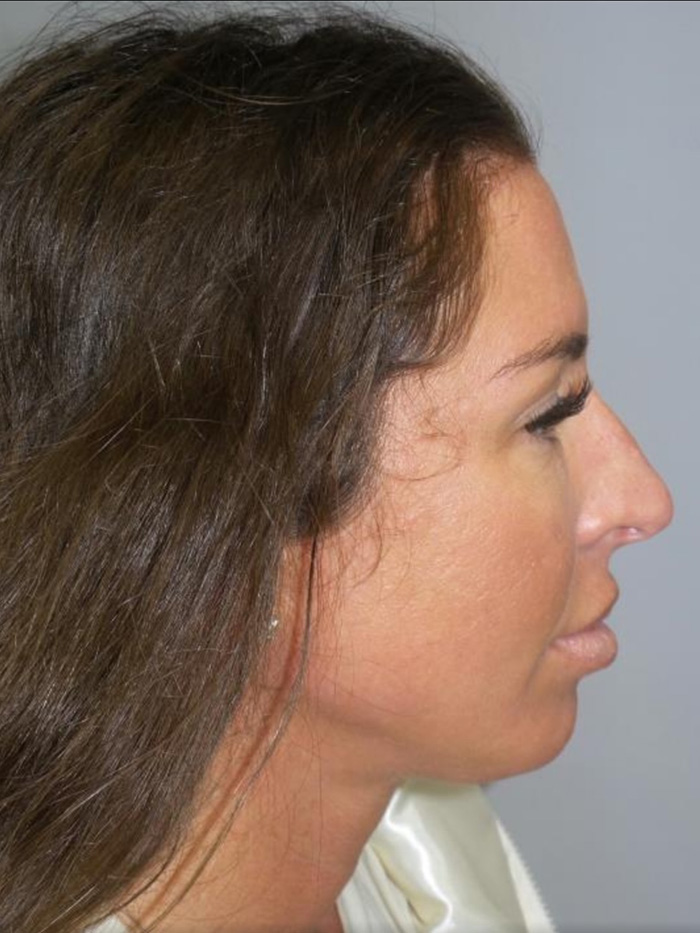 Chin Augmentation Before and After 07 | Sanjay Grover MD FACS