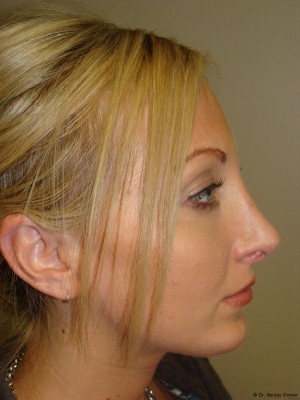 Chin Augmentation Before and After | Sanjay Grover MD FACS