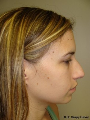 Chin Augmentation Before and After 07 | Sanjay Grover MD FACS