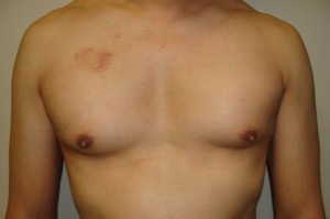 Nipple Reduction Before and After | Sanjay Grover MD FACS