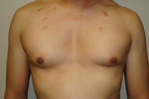 Nipple Reduction Before and After | Sanjay Grover MD FACS