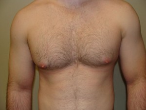 Nipple Reduction Before and After 07 | Sanjay Grover MD FACS