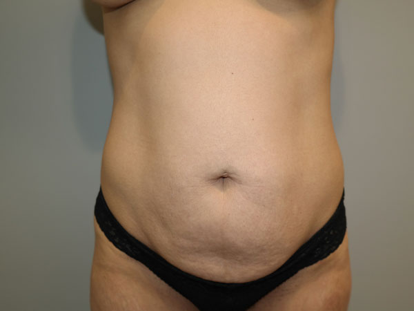 Tummy Tuck Before and After 106 | Sanjay Grover MD FACS
