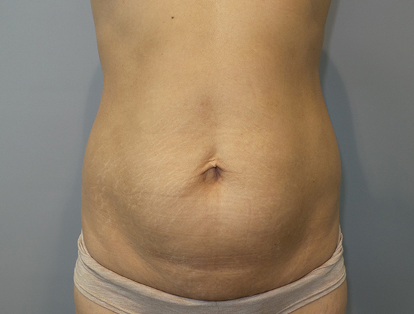 Tummy Tuck Before and After 101 | Sanjay Grover MD FACS