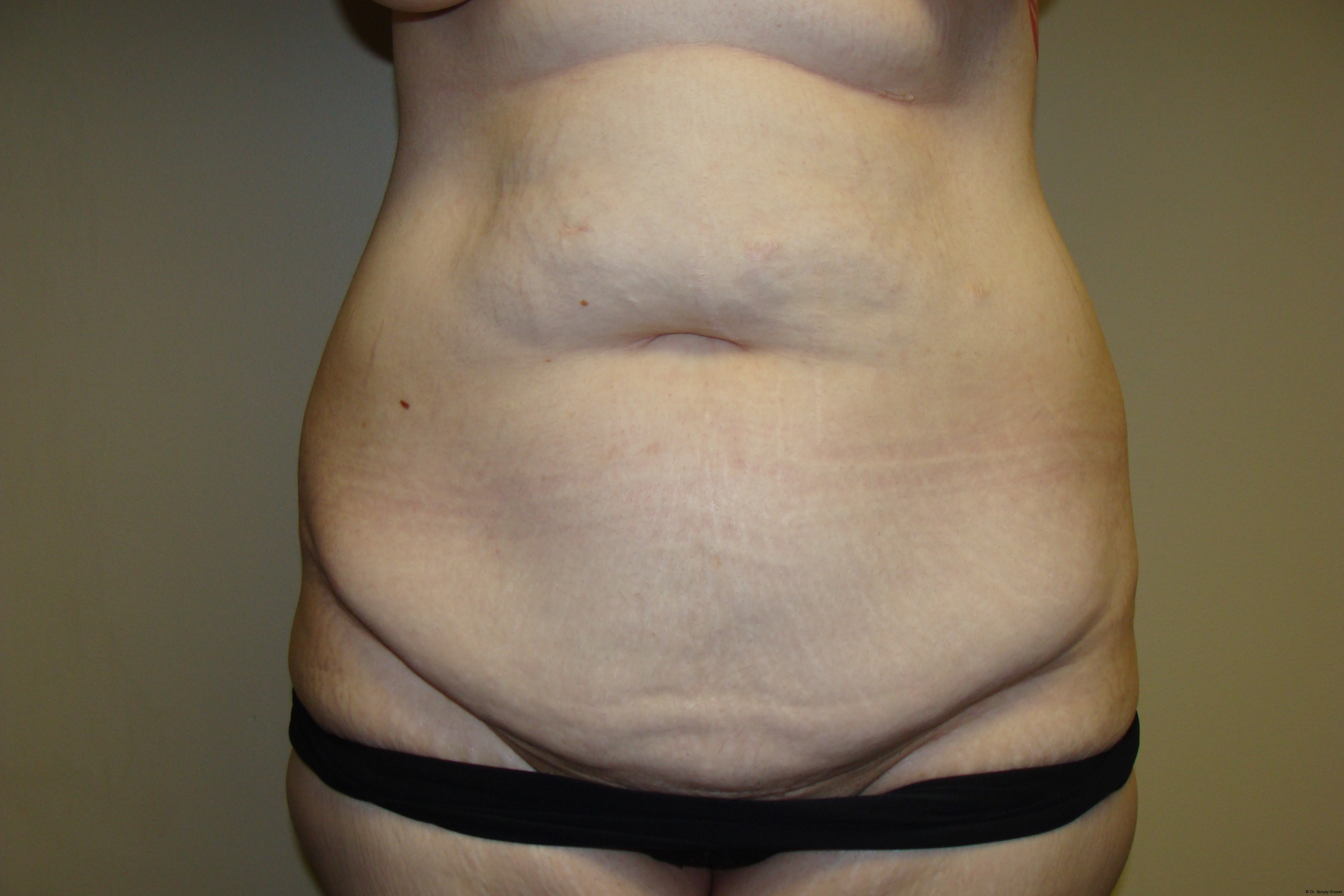 Tummy Tuck Before and After 15 | Sanjay Grover MD FACS