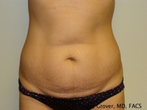 Tummy Tuck Before and After 47 | Sanjay Grover MD FACS