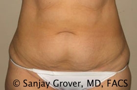 Tummy Tuck Before and After 14 | Sanjay Grover MD FACS