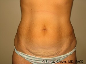 Tummy Tuck Before and After 55 | Sanjay Grover MD FACS