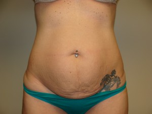 Tummy Tuck Before and After 66 | Sanjay Grover MD FACS