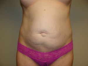 Tummy Tuck Before and After 12 | Sanjay Grover MD FACS
