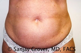 Tummy Tuck Before and After 111 | Sanjay Grover MD FACS