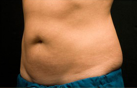 Coolsculpting Before and After 05 | Sanjay Grover MD FACS