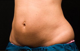 Coolsculpting Before and After 15 | Sanjay Grover MD FACS