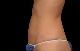 Coolsculpting Before and After | Sanjay Grover MD FACS