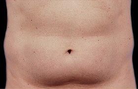 Coolsculpting Before and After 04 | Sanjay Grover MD FACS