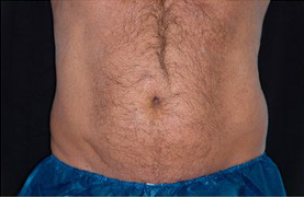 Coolsculpting Before and After 20 | Sanjay Grover MD FACS