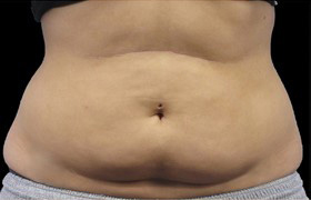 Coolsculpting Before and After 13 | Sanjay Grover MD FACS